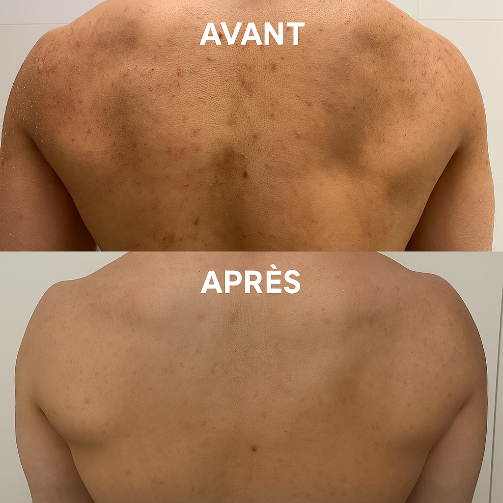 GlovolyskinÂź - Bande Exfoliante pour le Dos